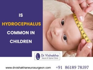 Read more about the article Is hydrocephalus common in children