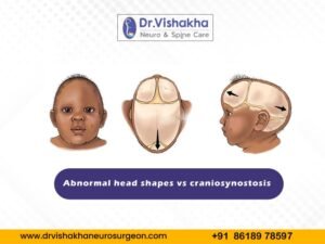 Read more about the article Abnormal head shapes vs craniosynostosis