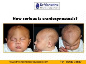 Read more about the article How serious is craniosynostosis?