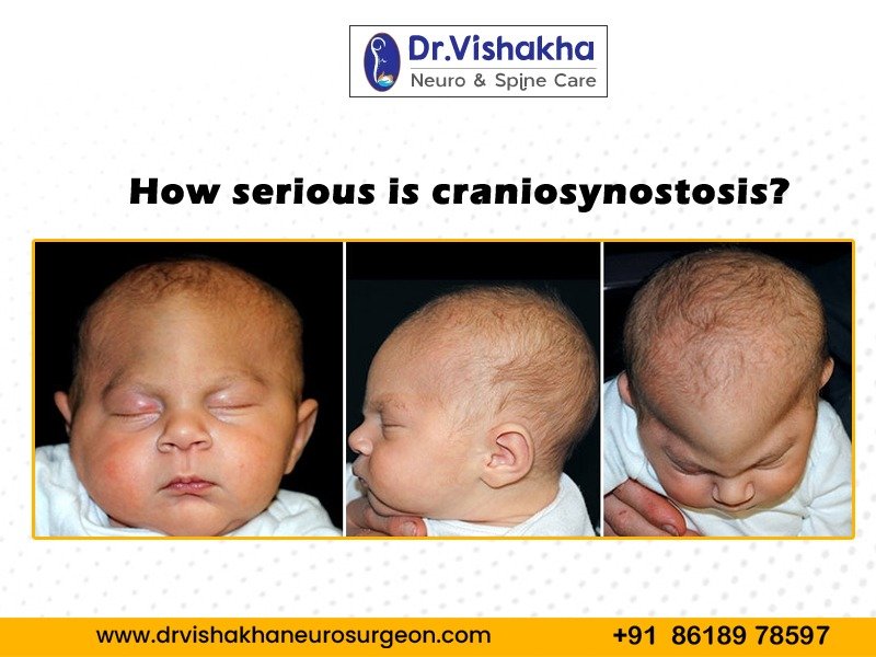 You are currently viewing How serious is craniosynostosis?