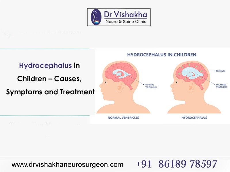 You are currently viewing Hydrocephalus in Children – Causes, Symptoms and Treatment