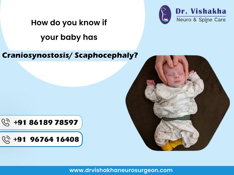 You are currently viewing How do you know if your baby has Craniosynostosis/ Scaphocephaly? Dr Vishakha Paediatric neurosurgeon