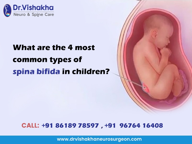 You are currently viewing What are the 4 most common types of spina bifida in children?