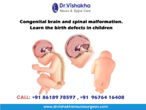 Read more about the article Congenital brain and spinal malformation. Learn the birth defects in children