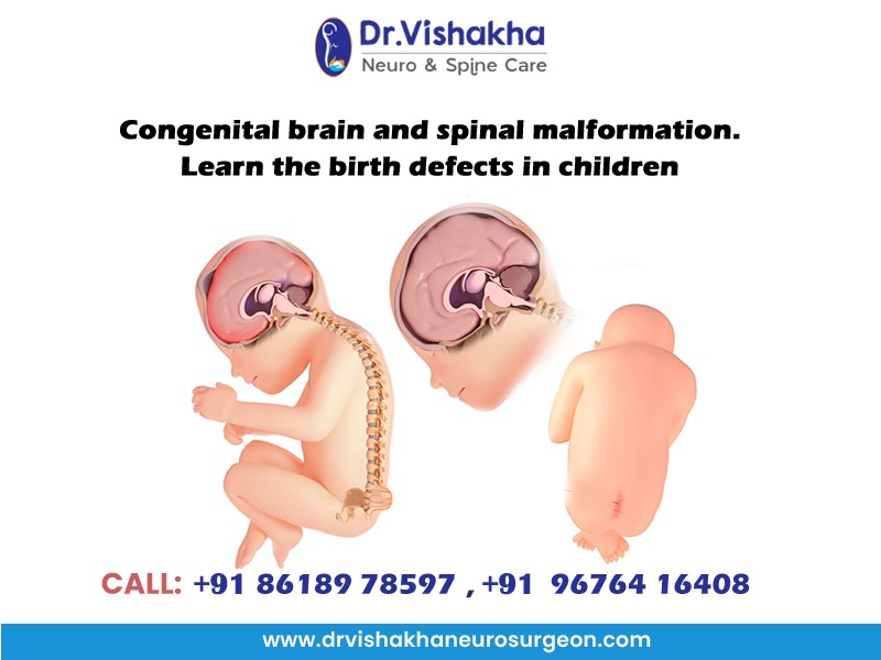 You are currently viewing Congenital brain and spinal malformation. Learn the birth defects in children