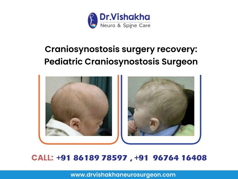 You are currently viewing Craniosynostosis surgery recovery: Pediatric Craniosynostosis Surgeon