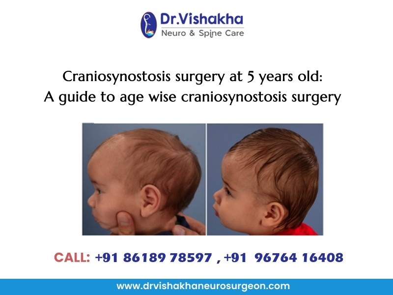 You are currently viewing Craniosynostosis surgery at 5 years old: A guide to age-wise craniosynostosis surgery