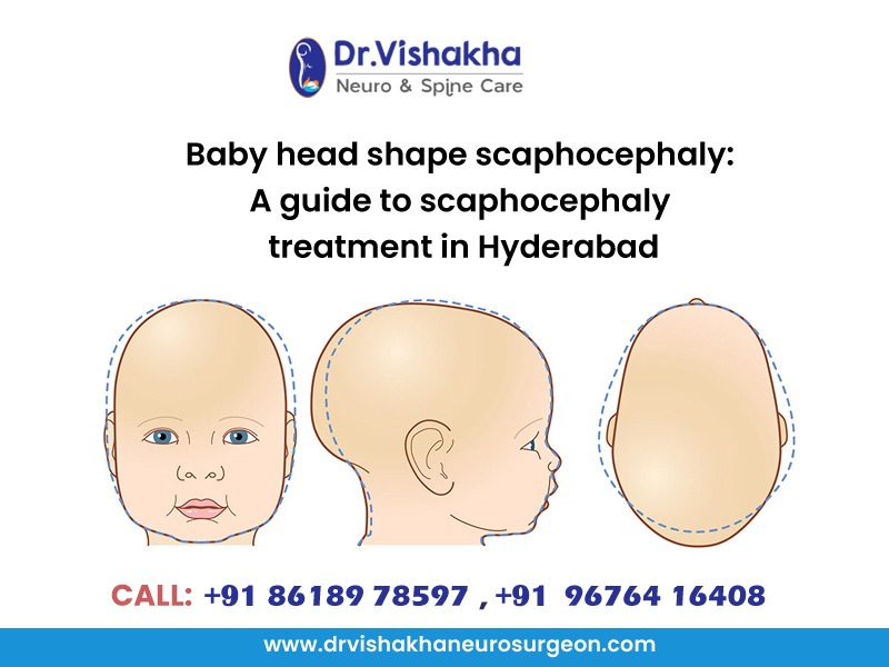 You are currently viewing Baby head shape scaphocephaly: A guide to scaphocephaly treatment in Hyderabad
