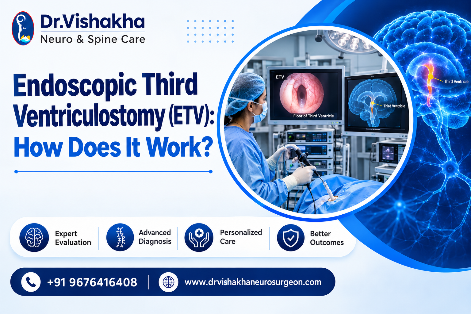 You are currently viewing Endoscopic Third Ventriculostomy (ETV): How Does It Work?
